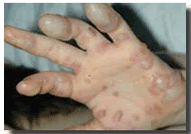 Toxic Epidermolysis
